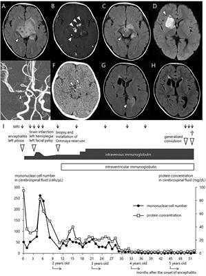 Fatal Progressive Meningoencephalitis Diagnosed in Two Members of a Family With X-Linked Agammaglobulinemia